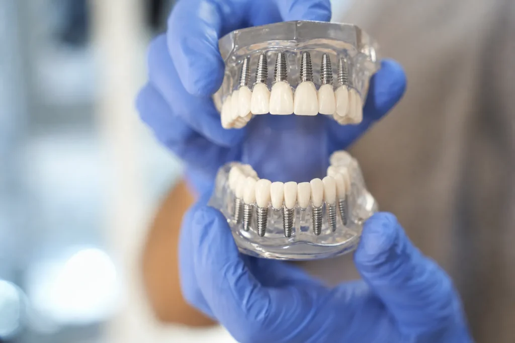 Full-arch implant models held in gloved hands