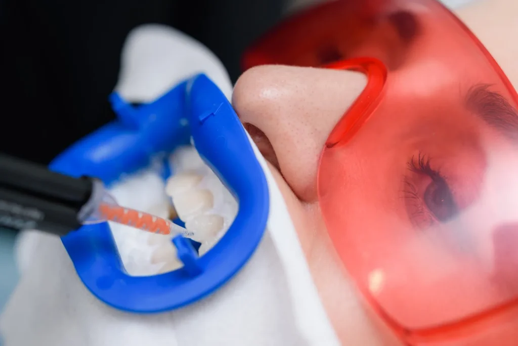 Whitening gel being applied with a cheek retractor in place