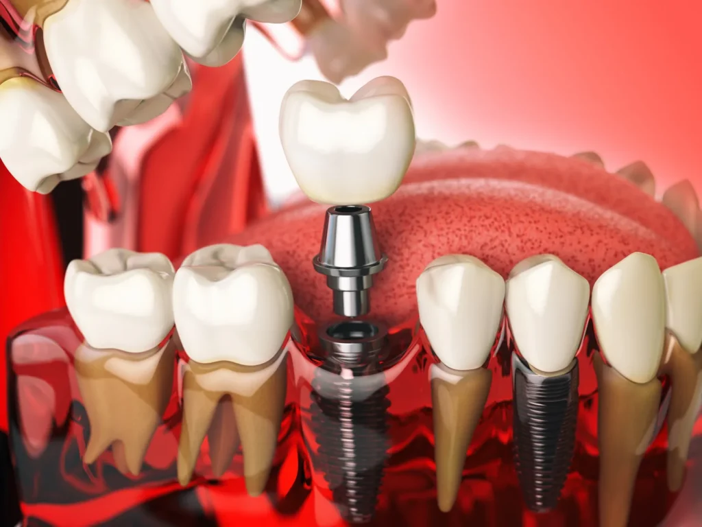 An illustration of a crown seated on a tooth